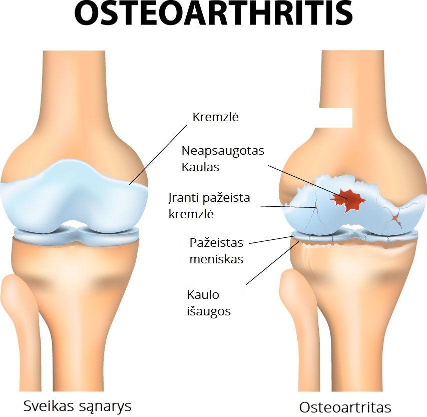kojos kelio sąnarių skausmas osteoartrozė nuo alkūnės jungties 2 laipsnių gydymo