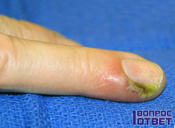 reumatoidinio artrito alkūnės sąnario medicinos apyrankės ant rankos artritas