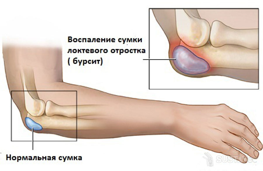 skausmas mėta sąnarių artritas ir alkūnės sąnario dešinės rankos