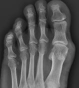 podagra x ray findings