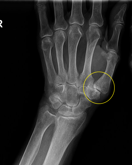 rankos nykščio po traumos sąnario kaip gydyti artritą namuose