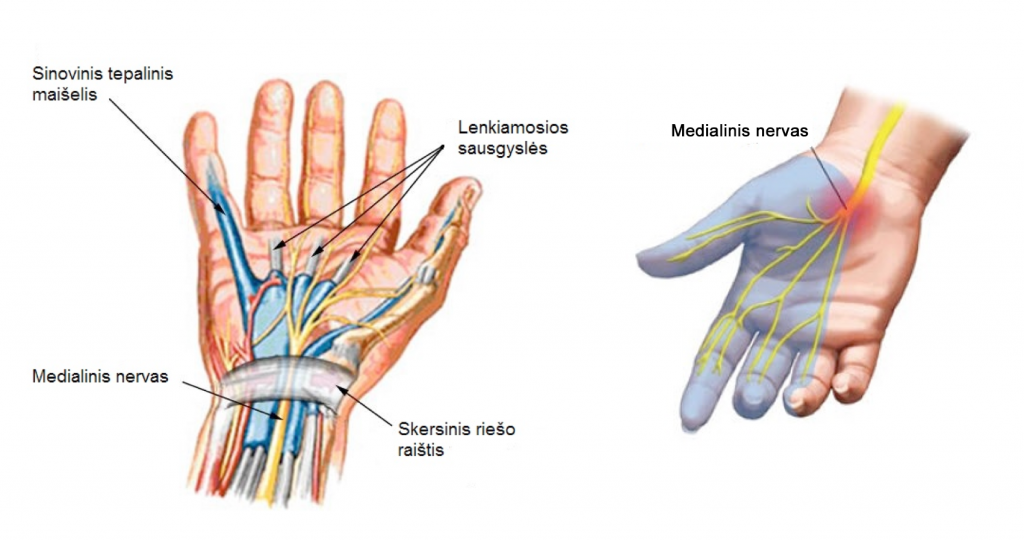 rankos riešo skausmas gydo piršto skausmo