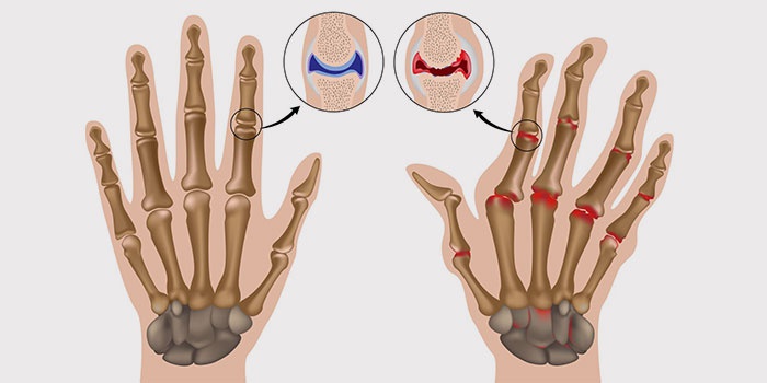 reumatinės artritas rankų šepečiai išlaikyti ligos riešo