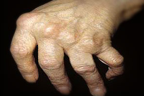 reumatoidinis artritas sąnarių skystis gerklės sąnarių peties gydymas