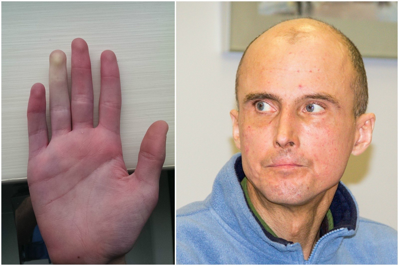 paauglių liga sąnarių skausmas artritu rankas