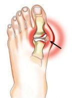 skausmas pėdos sąnarių sustaines po sulaužytas gydymo