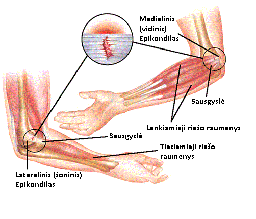 kaires rankos raumenu skausmas patinsta skauda kojas