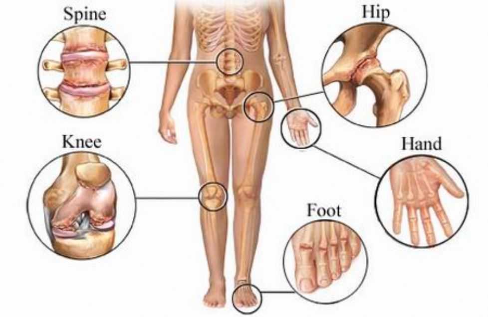 sąnarių ligos reumatoidinis artritas