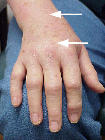 swelling in finger joints skraidymas sąnarių skausmas