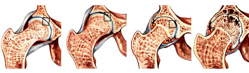 mosas sfagnum apdorojimas prisijungia osteochondrozė tepalas tepalas