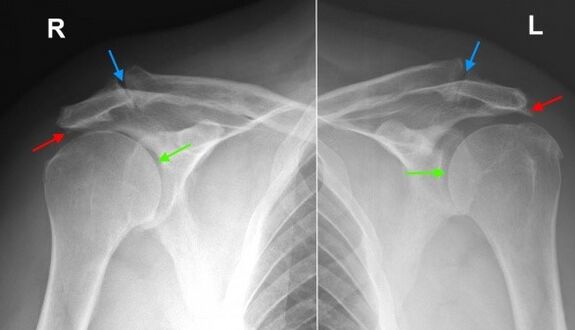 trauminio artrozė gydymas sunkus skausmas dešinėje sąnarių