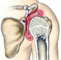 trauminio artrozė peties sąnario artrozė sąnarių priežastys ir gydymas