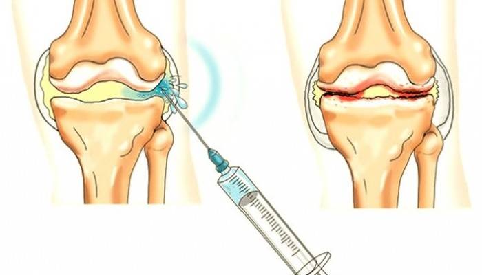apatinės nugaros dalies skausmo gydymui kaklo tepalas homeopatiniai gydymas gydant sąnarių