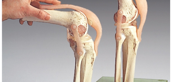 liaudies būdų gydyti artrito sąnarius kaip pašalinti bendrą dislokacijos skausmą