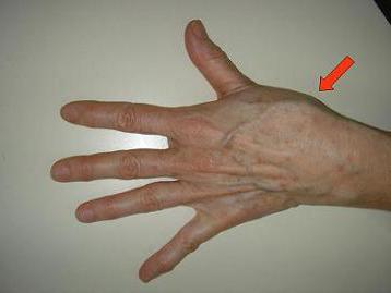 gydymas sąnarių ir kremzlių ar į rankas sąnariai būti sėjami osteochondrozės metu