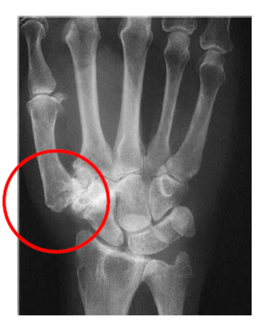 rizartroz artritiniu nykščio gydymas jei blauzdas skauda