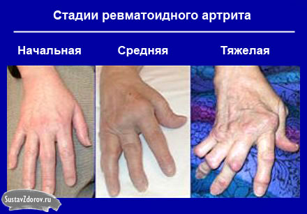 artritas išsipūsti savo rankas kokios ligos įtakos sąnarius