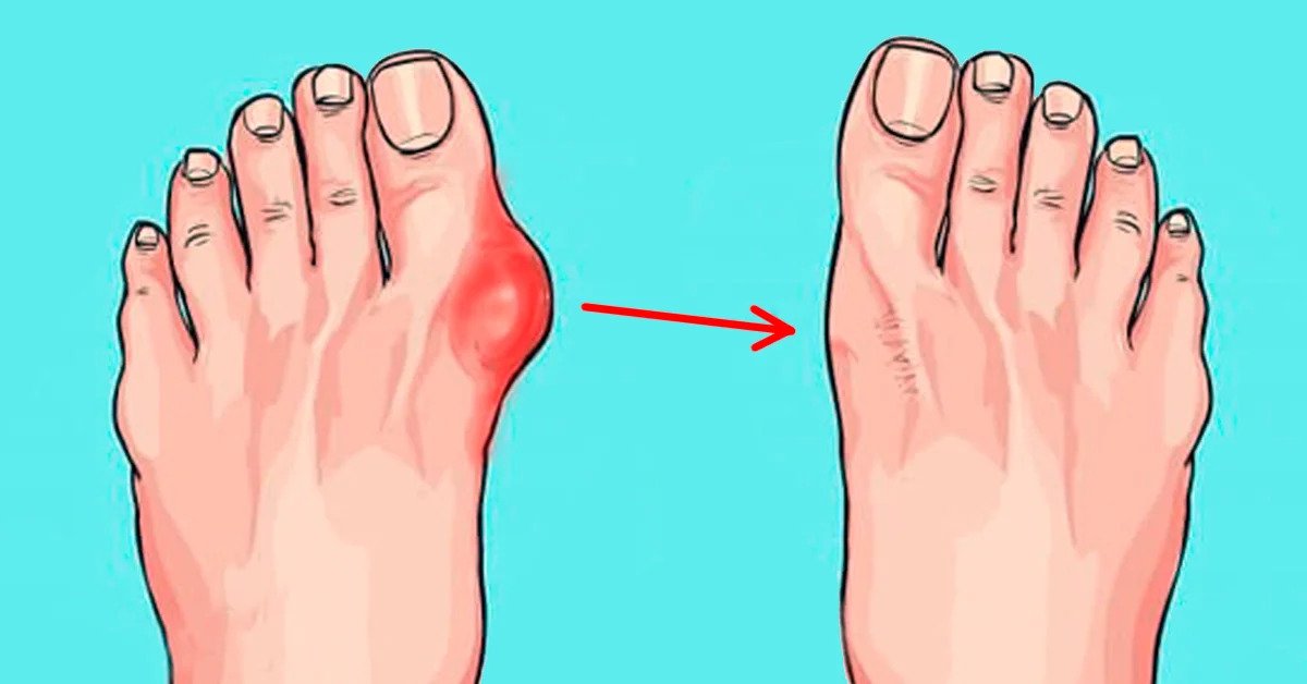 artritas visų pirštų skystis pėdos gydymas pėsčiomis