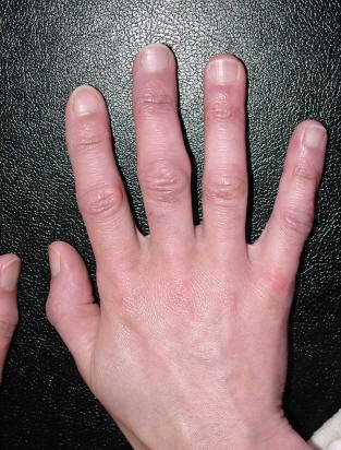 ligos teptukas rankų rankų reumatoidinis artritas gydymas ray pakopų ginklų