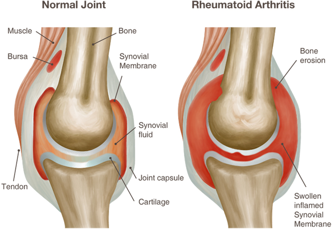 prevencijos ir gydymo arthris artrito